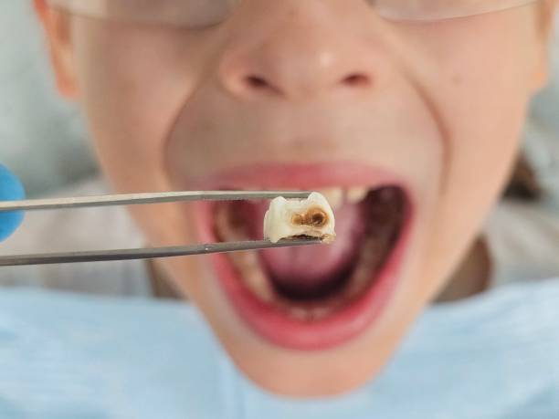 Best Emergency Tooth Extraction in Masontown, PA